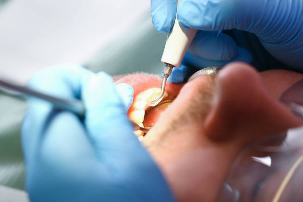 Best Emergency Root Canal Treatment in Lisbon, ME